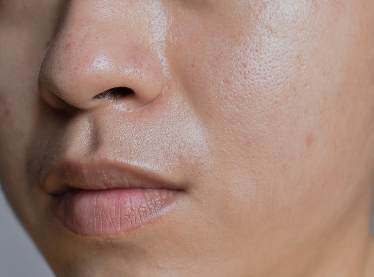 Have Oily Skin? Here Are Some Effective Tips To Reduce Shine