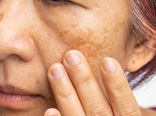 What Causes Pigmentation On Skin And How To Treat It?