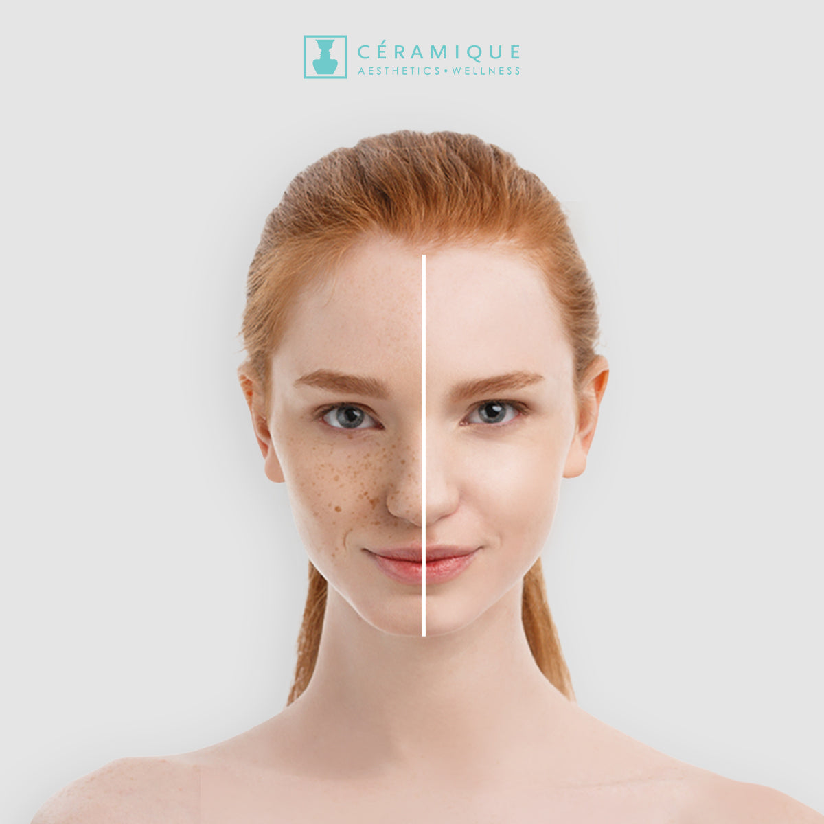Pigmentation